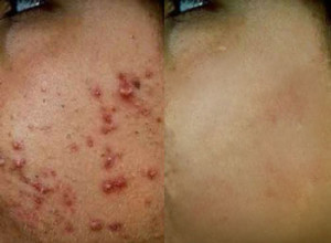 acne before and after photos